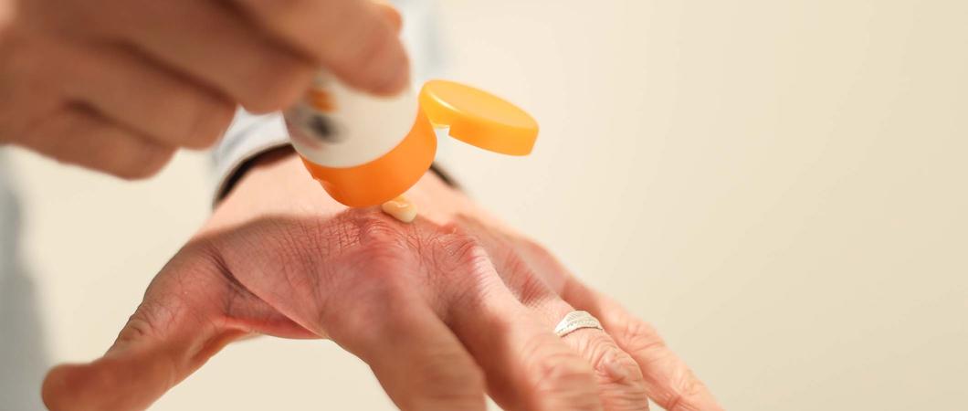 Bei Temperaturen um den Gefrierpunkt wird die Haut rissig und schuppig